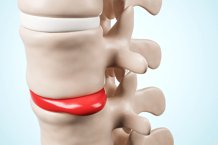 椎間板ヘルニアのイメージ画像
