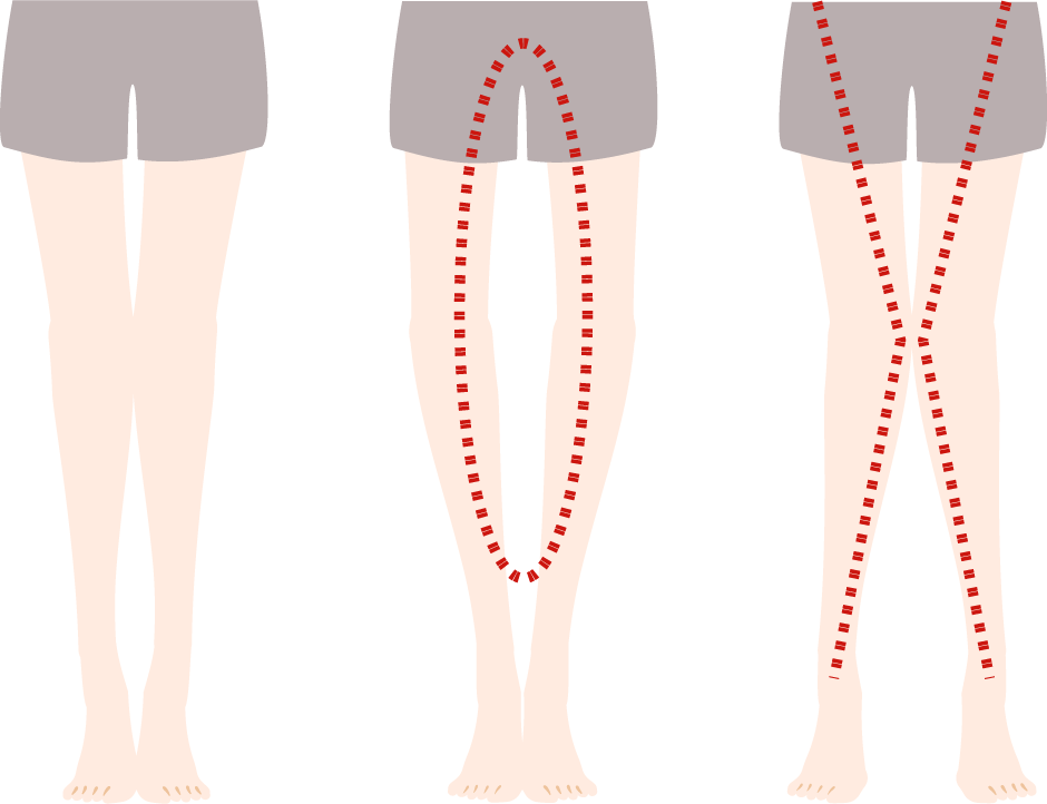 O脚やX脚と正常な状態の比較画像